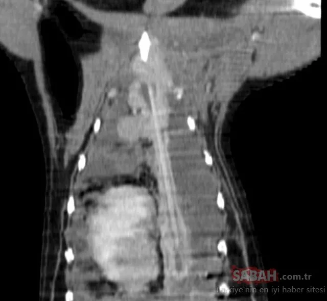 Son dakika haberi: Ultrason’da şoke eden görüntü! Göğsünden 20 cm’lik...