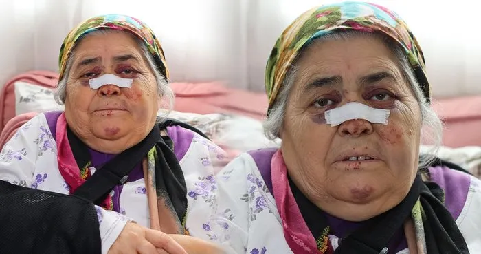 Adana’ya yaşlı kadına kabusu yaşattı! Önce çarptı sonra kaçtı: Vücudumun sağ tarafı…