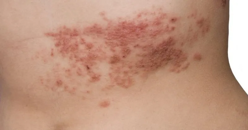 zona hastaligi belirtileri nelerdir