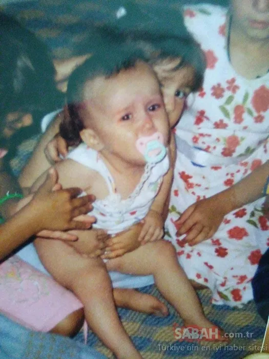 20 yıllık zorlu mücadele ve mutlu son: 49 ameliyatla yeni yüz