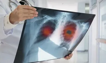 “Ciğerlerde kalan Covid-19 nodülleri akciğer kanseri başlangıcı olabilir”