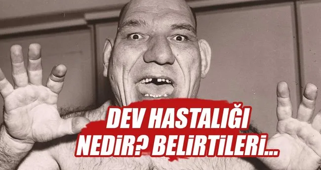 Dev Hastaligi Nedir Agromegali Nedir Dev Hastaligi Belirtileri Nelerdir Saglik Haberleri