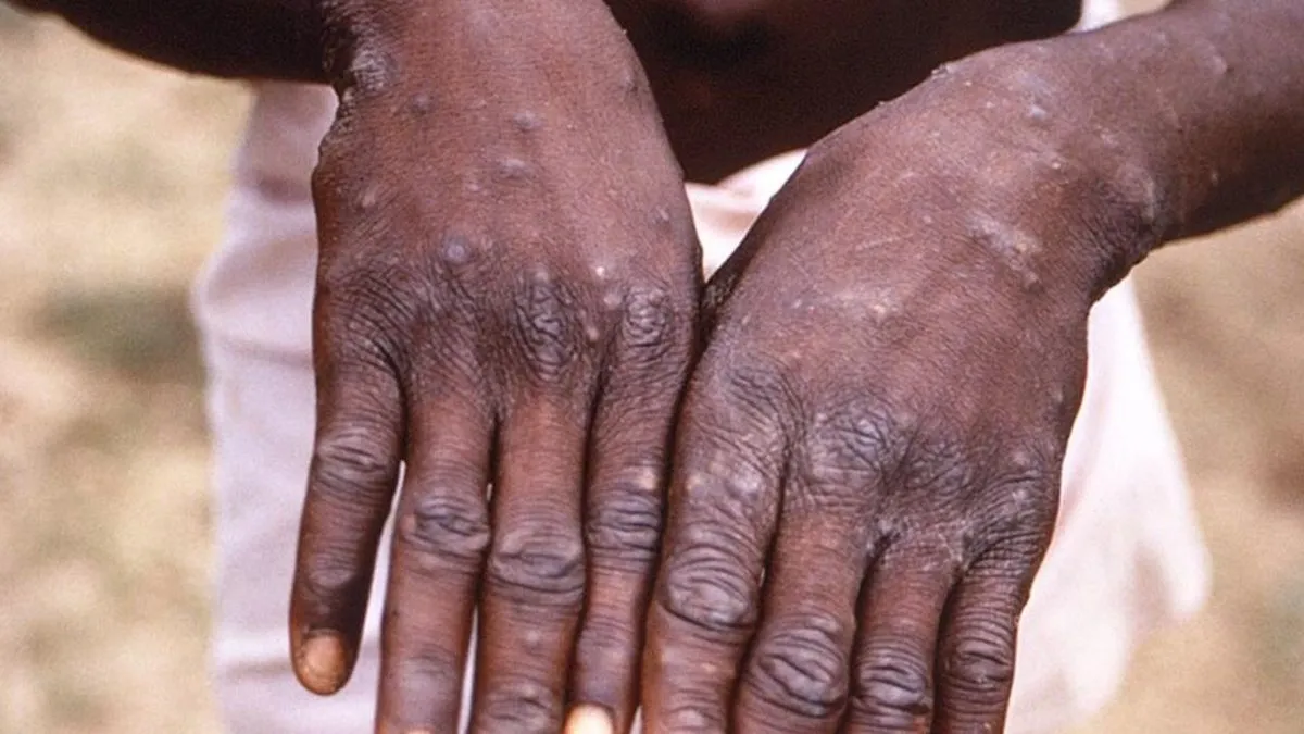 BM, Afrika'da giderek artan M çiçeği virüsünün kıta dışına yayılmasından endişeli