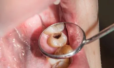 Diş çürüğünden kurtulmanın mucizevi yolları