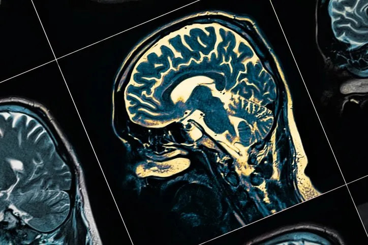 Alzheimer’ın en büyük 3 nedeni! Sinir bilimci beyni korumanın yöntemini anlattı...