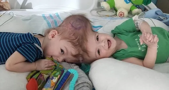 Kafalarından yapışık olan ikizler ilk kez birbirini gördü!