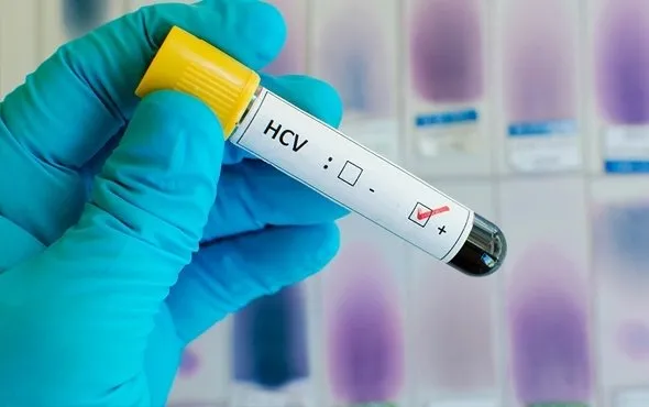 Hepatit C tedavi edilmezse karaciğer kanserine yol açabilir