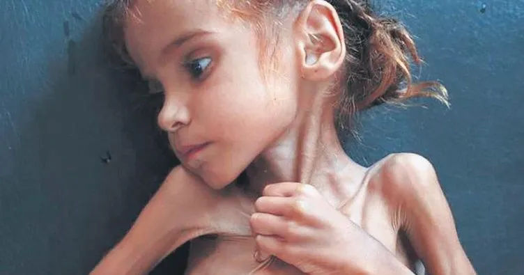 Yemenli Emel açlıktan öldü