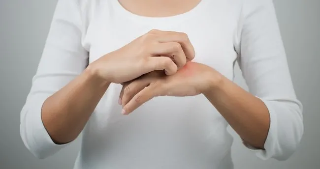 evde uyuz tedavisi icin sirke nasil