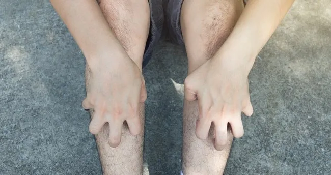 bacaklarda kasinti ve kizariklik neden olur dogal tedavi ile nasil gecer bacakta kasinti neyin hangi hastaligin belirtisi saglik haberleri