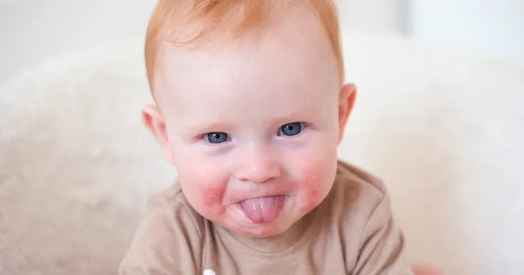 Bebeklerde ağız içi aft ile dil yarası nasıl geçer, tedavisi var mı? Bebeklerde ağız yarasına ne iyi gelir?