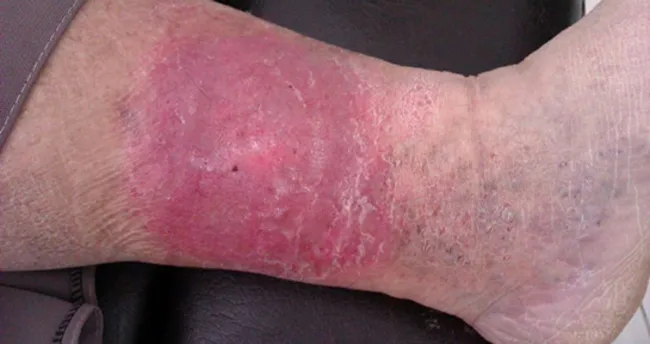 varis ulseri nasil tedavi edilir