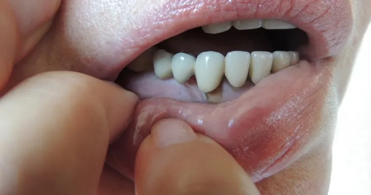 Şiş ve kırmızı diş etlerine dikkat