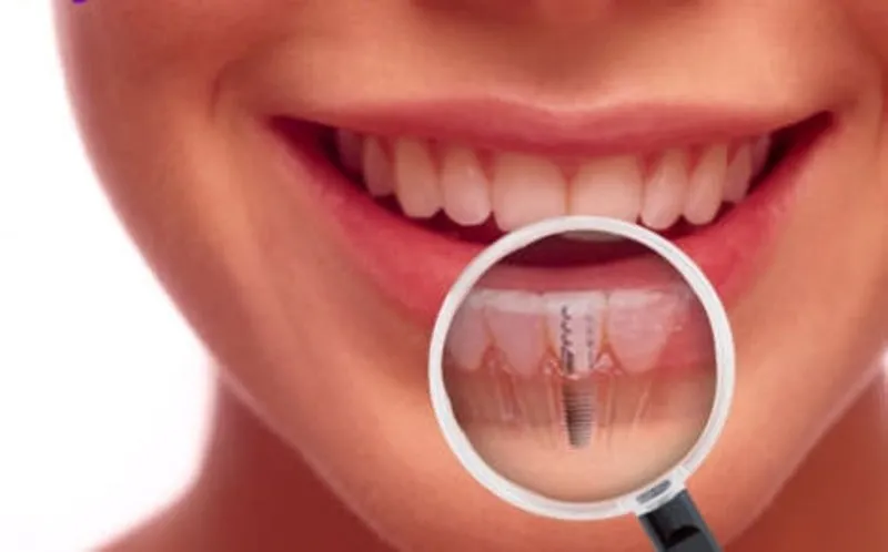 Implant Ile Saglikli Dislere Kavusun Son Dakika Haberler