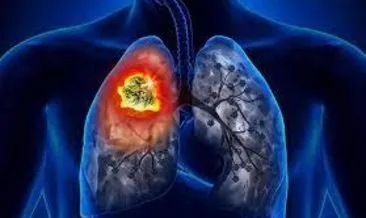Akciğer kanseri ölüm sıralamasında ilk sırada