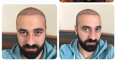 Habersiz saç ektirdi takımdan kovuldu