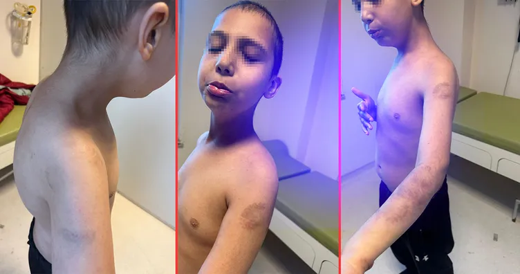 Özel bakım merkezinde otizmli çocuğa şiddet: Vücudu morardı! Beğenmiyorsanız kendiniz baksaydınız!