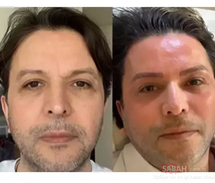 Estetikli halini gören tanıyamadı! Ünlü türkücü Nihat Doğan 10 yaş gençleşti