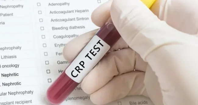 Crp Nedir Crp Hangi Durumlarda Yukselir Saglik Haberleri