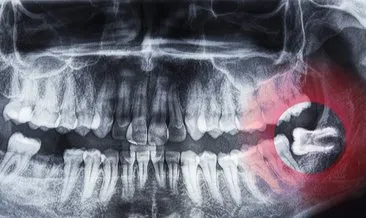 Çene ve ağız sağlığını bozuyor! Gömülü 20’lik diş sorununun çözümü...