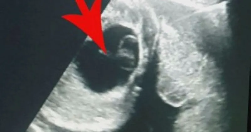 kisti belirtileri nelerdir