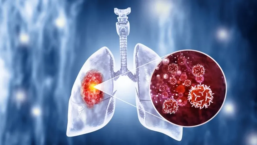 Dikkat! Bu kişilerin akciğer kanseri riski 20 kat daha fazla: En ölümcül kanser türü..