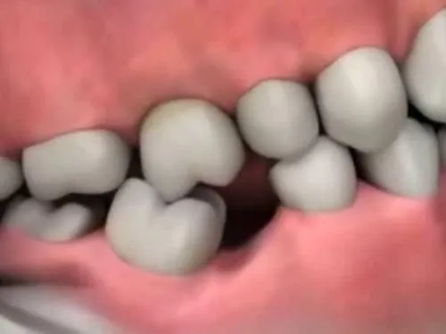 Eksik dişin 8 zararı