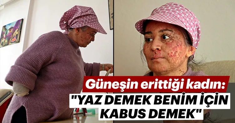 Bu kadın güneşe çıkamıyor