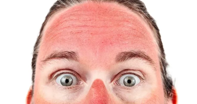 Saat 10.00 ile 17.00 arasında güneşe çıkmayın!