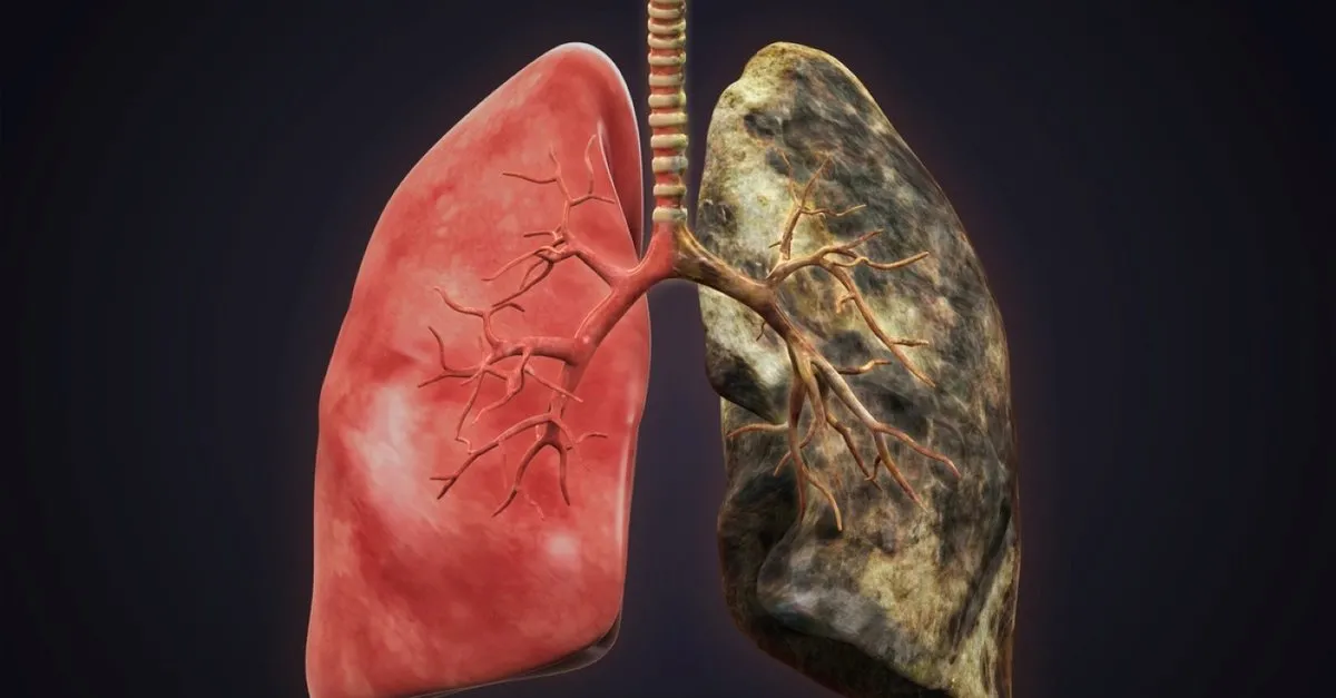 Akciğer sertleşmesi kanserden daha tehlikeli… - Sağlık Haberleri