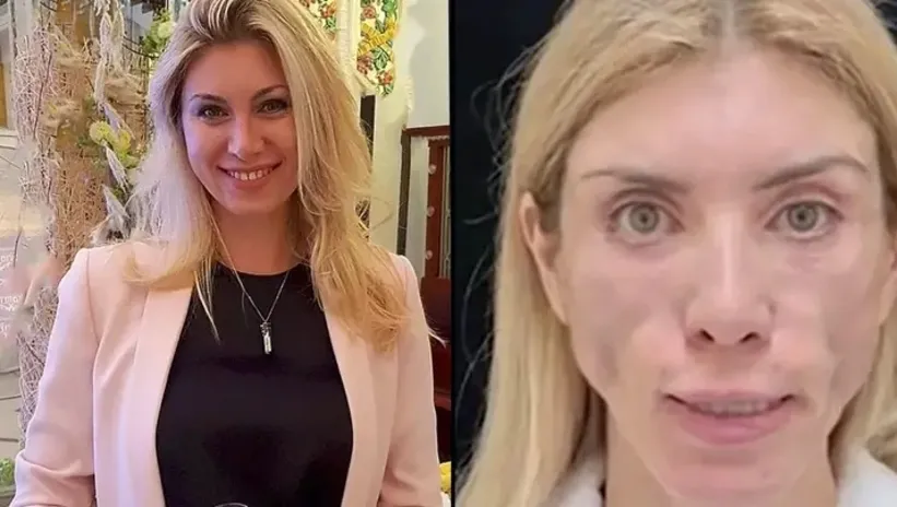 Kraliçenin hayatı kabusa döndü! Estetik sonrası gözlerini kapatamıyor