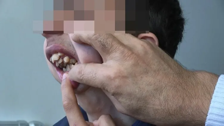 Liseli gencin yardım çığlığı: Alt çenesi yok dişleri üst damağında
