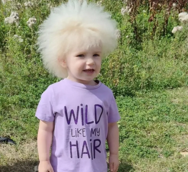 Dünyada sadece 100 kişide görülüyor! 3 yaşındaki kızın saçlarını gören inanamıyor…