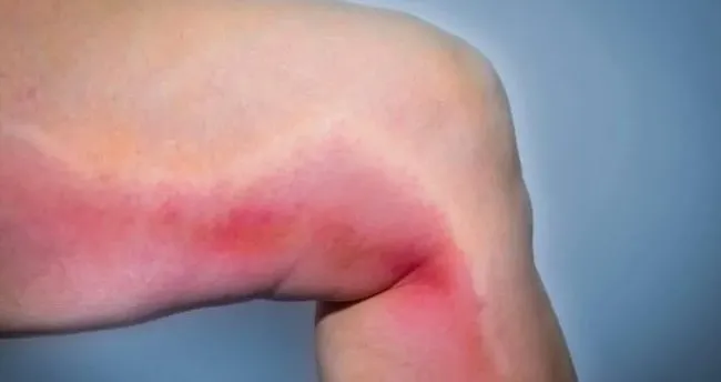 pihti atmasi neden olur pihti atmasinin tedavisi nasil yapilir saglik haberleri