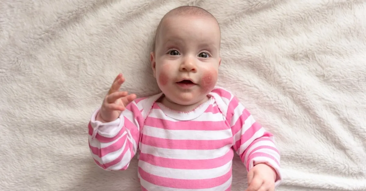 Cocuklarda Sik Gorulen Cilt Lezyonlarindan Biri Egzama Cocuk Haberleri