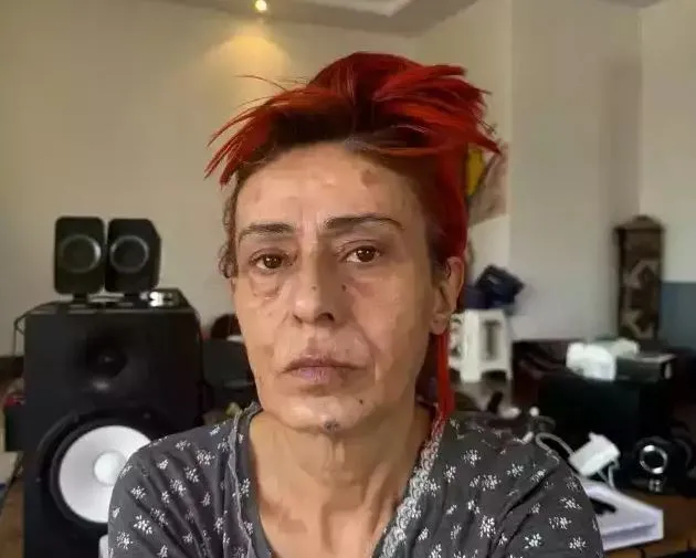 Yıldız Tilbe’nin yüzü yandı! Korkutan görüntüyü sosyal medyasında paylaştı: Geçer inşallah