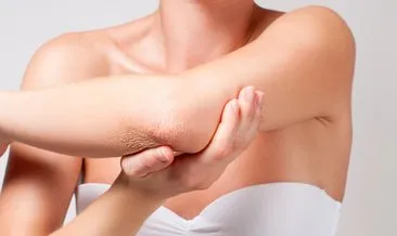 diz ve dirseklerinizde kararma varsa