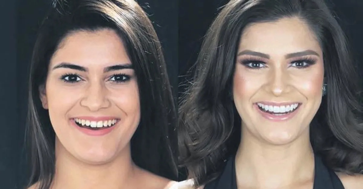 gulus yenilemesinde disler beyazlatilip