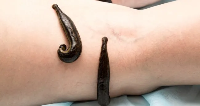 Unlulerin Tercihi Olan Suluk Tedavisinin Sagliga Ne Gibi Faydalari Bulunuyor Iste Suluk Tedavisine Dair Her Sey Saglik Haberleri