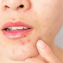 Bogaz Agrisina Iyi Gelen Seyler Bogaz Agrisina Ne Iyi Gelir Yutkunamama Problemi Nasil Gecer Son Dakika Haberler