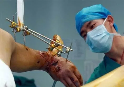 Çinli doktorlar kopan eli bacağa bağladı