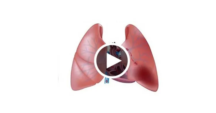 Akciğer embolisi nedir? Akciğer embolisi tedavisi...