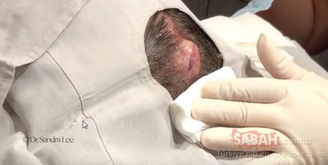 20 yıl bu şekilde yaşadı....Kafasından çıkanlar şoke etti!