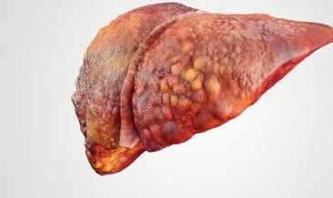 Karaciğer yağlanması belirtileri nelerdir? Tedavisi nasıl yapılır, ne kadar sürede geçer?