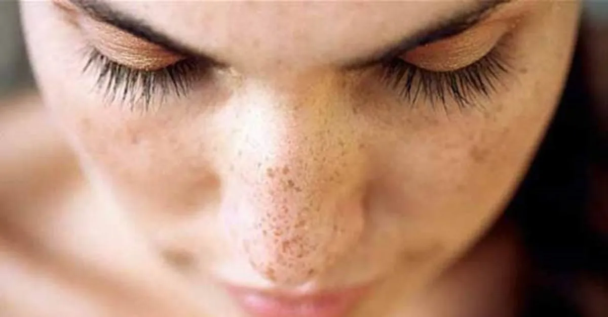 cil lekeleri neden olur cil lekeleri