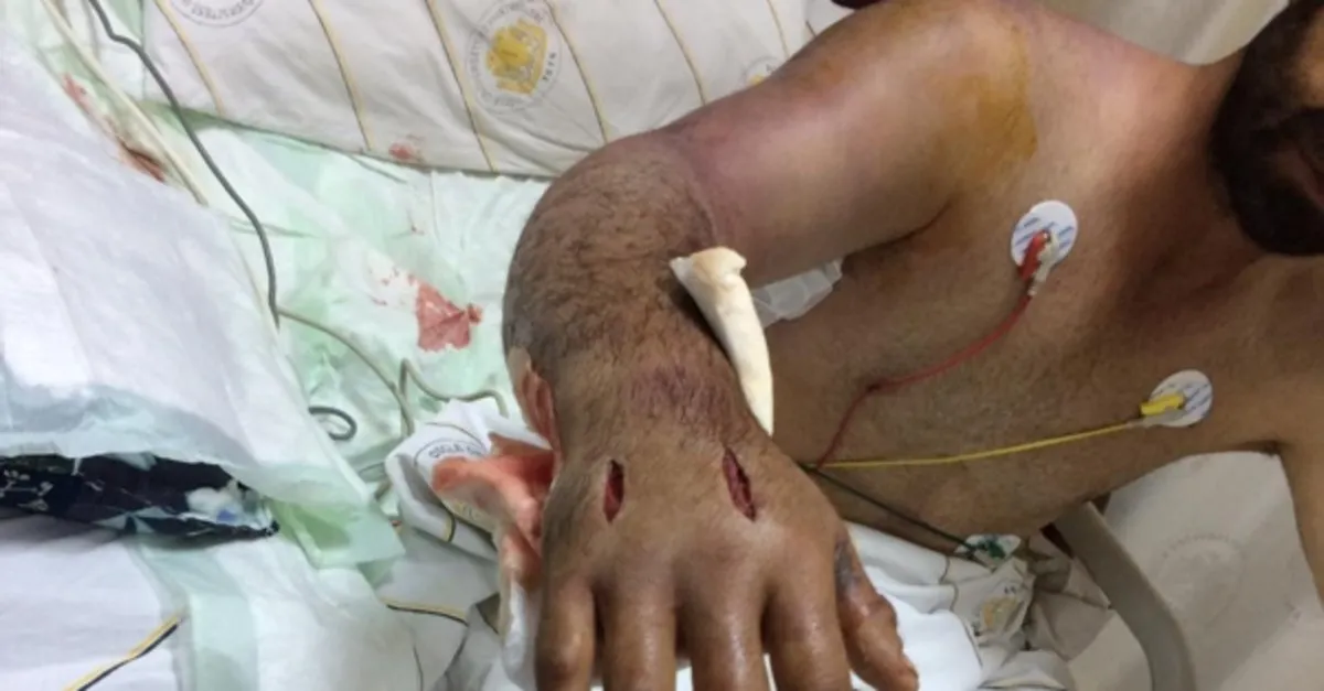 yilanin isirdigi adam yogun bakima