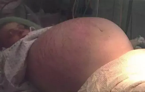 Hamile olduğunu düşünerek doktora gitti karnından çıkanlara kimse inanamadı! Tam 26 kilo ağırlığında...