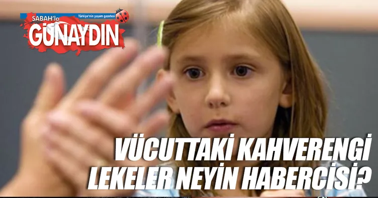 Doğum lekesi deyip geçmeyin!