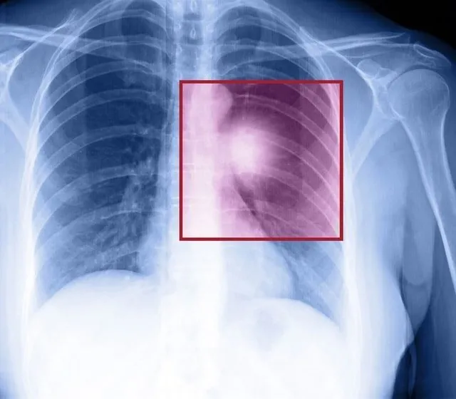 Akciğer kanserinin belirtileri nelerdir?