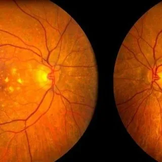 Sarı nokta hastalığı nedir, belirtileri nelerdir? Makula dejenerasyonu genetik mi?